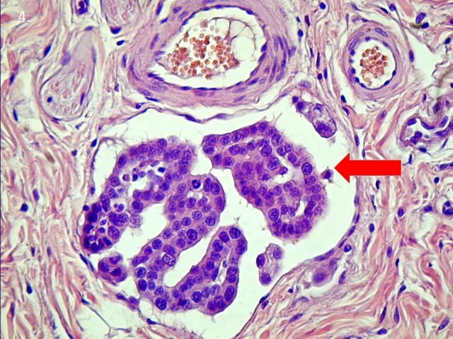4.-abra-Nyirokerben-sodrodo-emlomirigyrak-embolus-nyil-.jpg